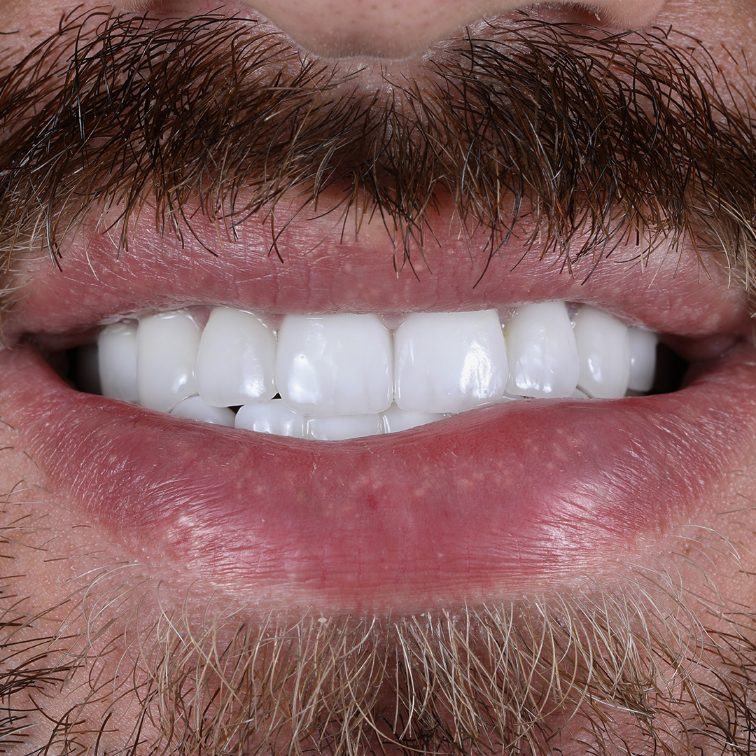 Results After Dental Veneer Surgery