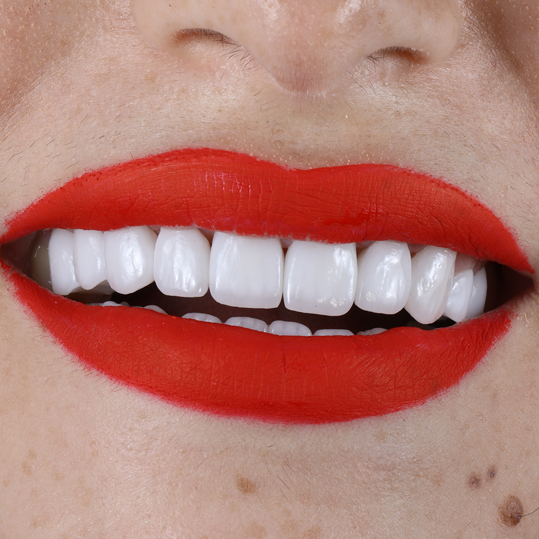 Results After Dental Veneer Surgery