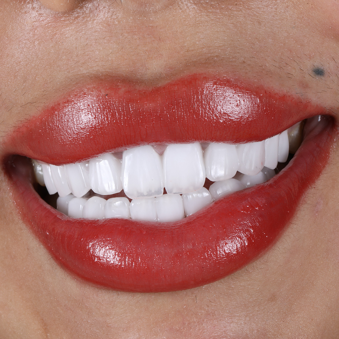 Results After Dental Veneer Surgery